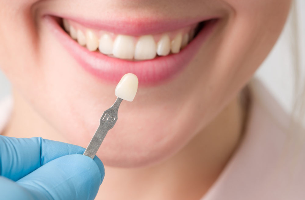 Faccette dentali: contro gli inestetismi ma non solo