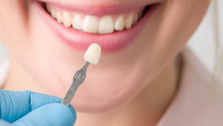 Faccette dentali: contro gli inestetismi ma non solo