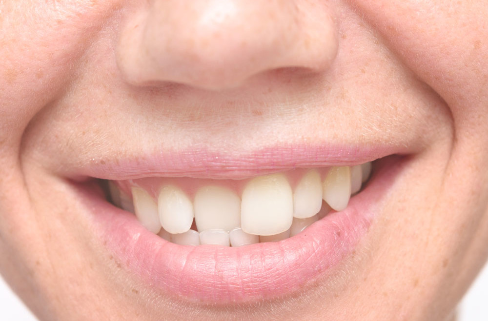 I denti storti, cause e rimedi