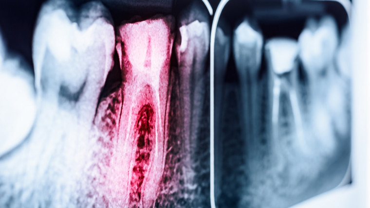 La radiologia dentale